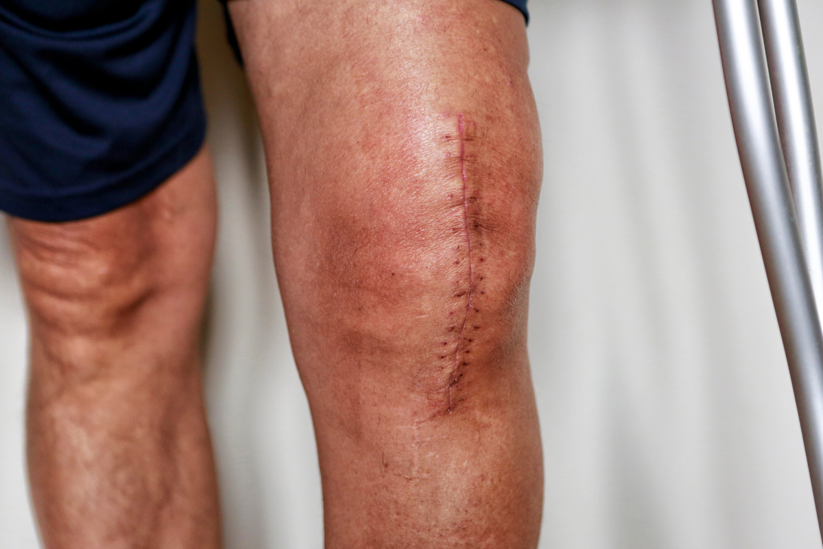 rigidez postoperatoria